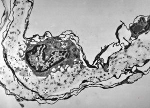 F,47y. | arachnoid cyst F,47y. | arachnoid cyst